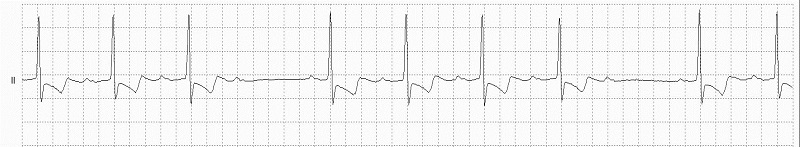 2° AV block Rhythm Strip